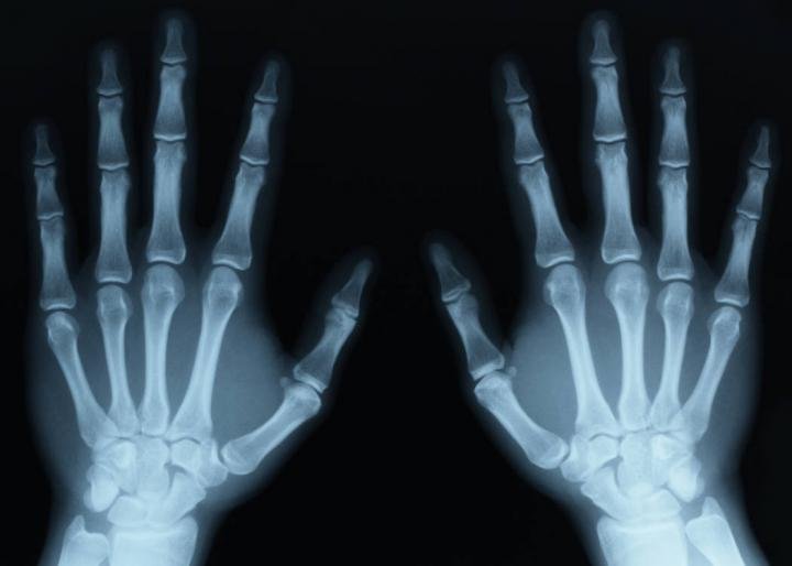Broken-Bones-X-ray-personal-injury-claims-Scotland